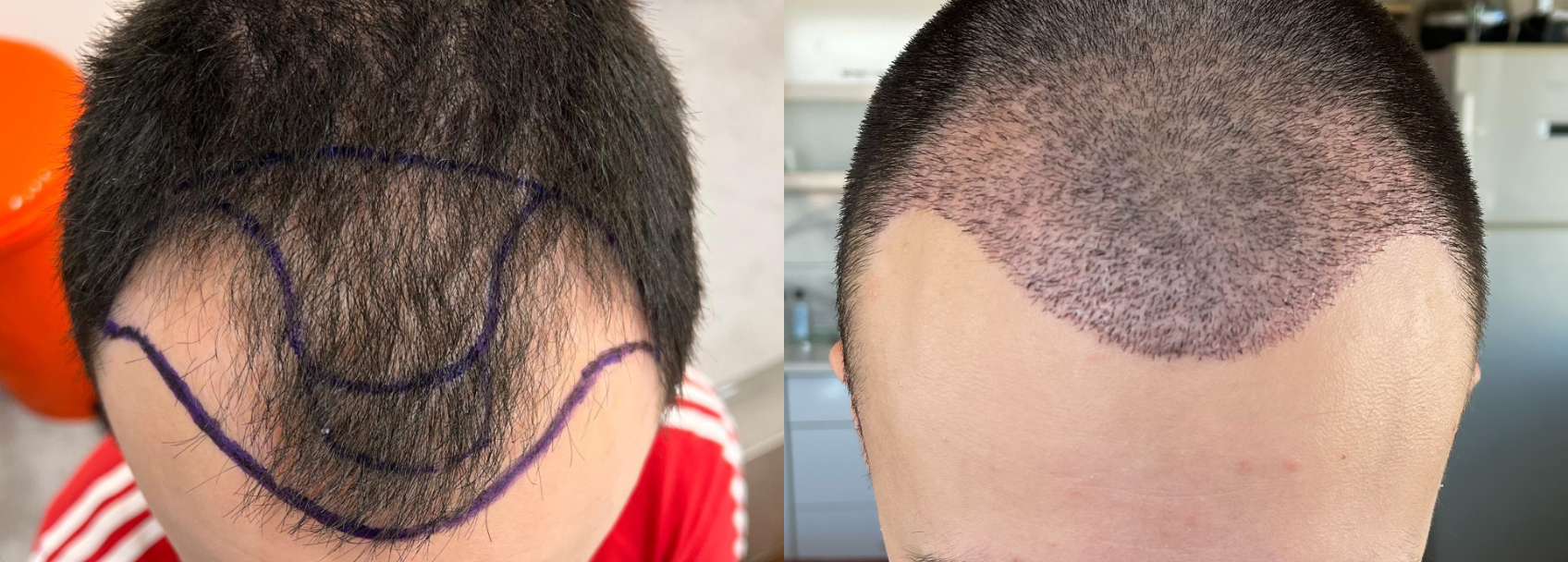 hair transplant