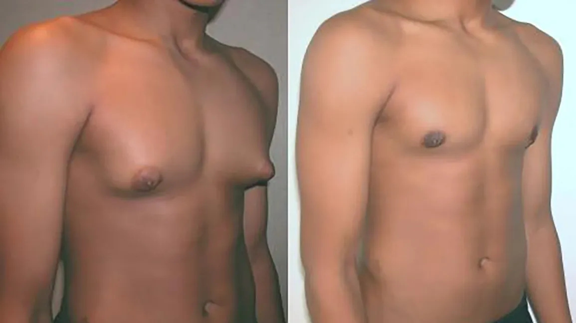 1_Adolescent_with_Gynecomastia