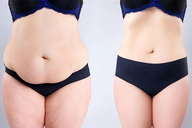 tummy-tuck-surgery