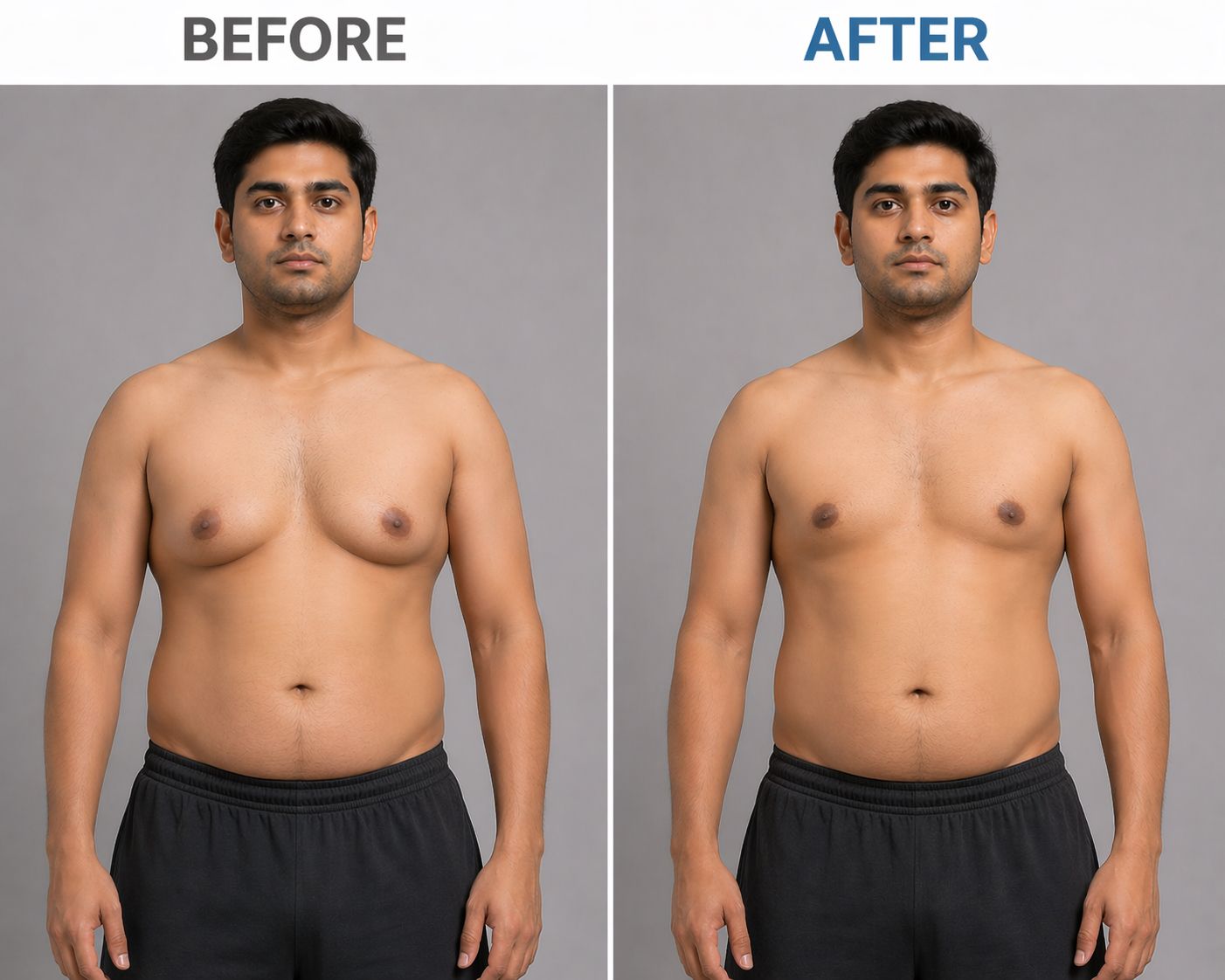 Gynecomastia · Gurgaon · Delhi NCR - TRUE Hospitals Gurgaon