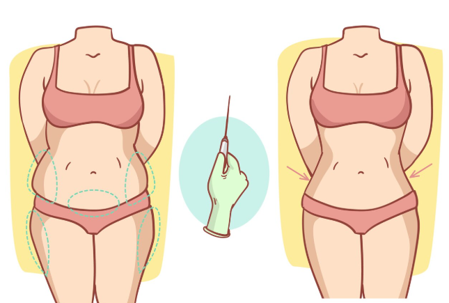 Liposuction Surgery in Gurgaon: Cost, Procedure, Benefits & Recovery Guide
