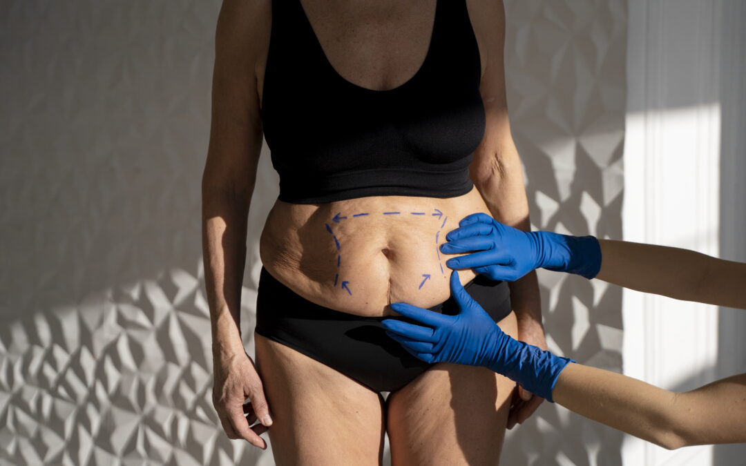  Is Liposuction Good for Weight Loss or Just Body Shaping?