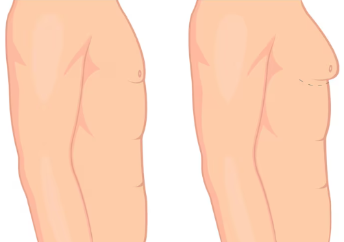 Your Complete Guide to Gynecomastia Treatment in Gurgaon