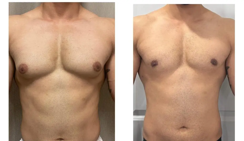 Gynecomastia Surgery in Gurgaon