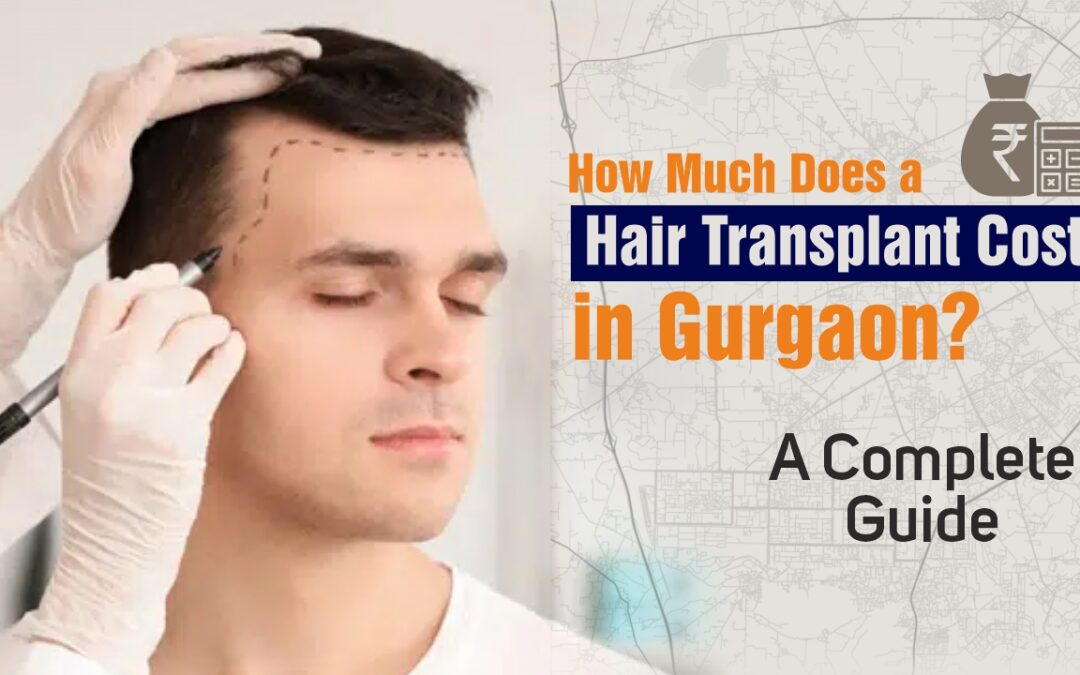 best hair transplant in Gurgaon