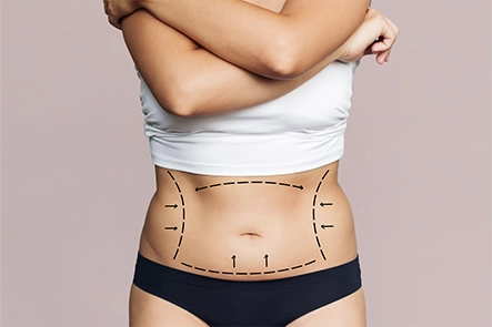 tummy tuck treatment in Gurgaon